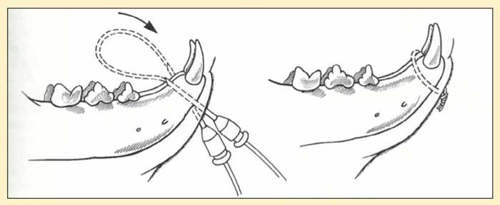 Techniques for intraoral fixation of jaw fractures