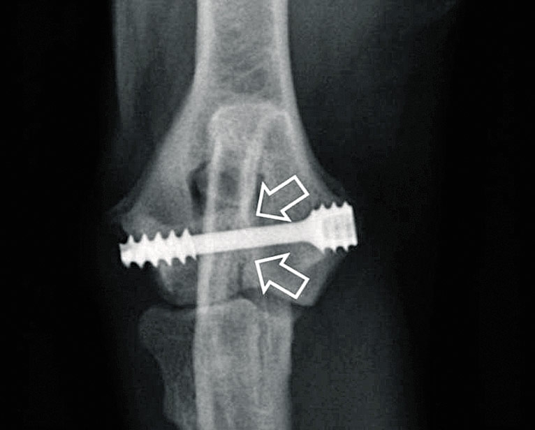 Update on humeral condylar fracture treatment in dogs