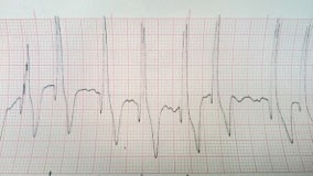 Management of atrial fibrillation