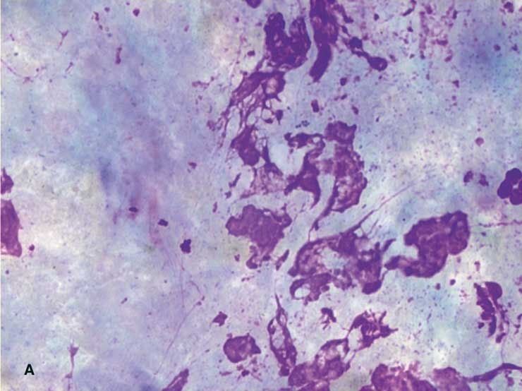 Basic cytology and approaches to examining fine needle aspirates