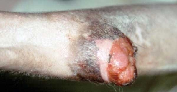 Largest research to date to probe soft tissue sarcoma