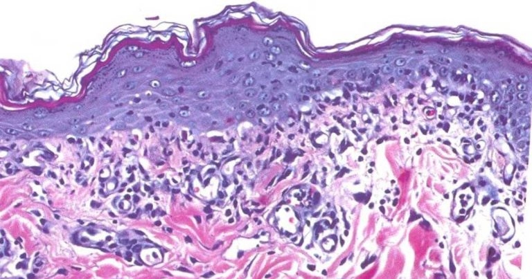 Recognising cutaneous variants of canine lupus erythematosus